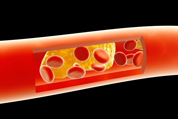 葉酸:動脈硬化を予防する