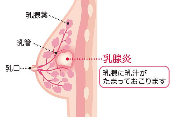 乳腺炎の原因